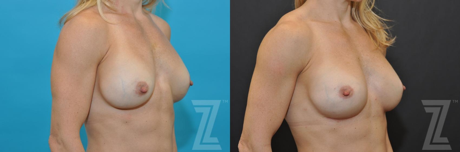 Austin Breast Augmentation Revision Before & After Gallery - Patient 132886580 - Image 4 - The Piazza Center