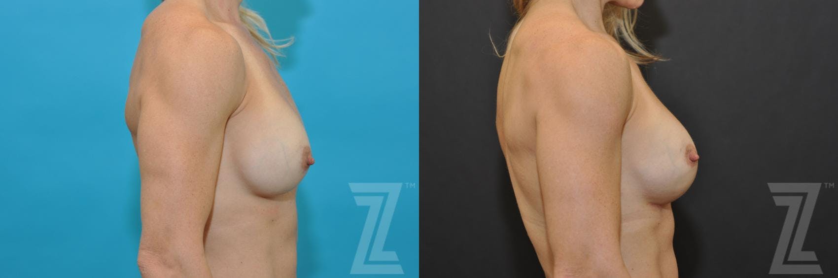 Breast Augmentation Revision Before & After Gallery - Patient 132886580 - Image 5