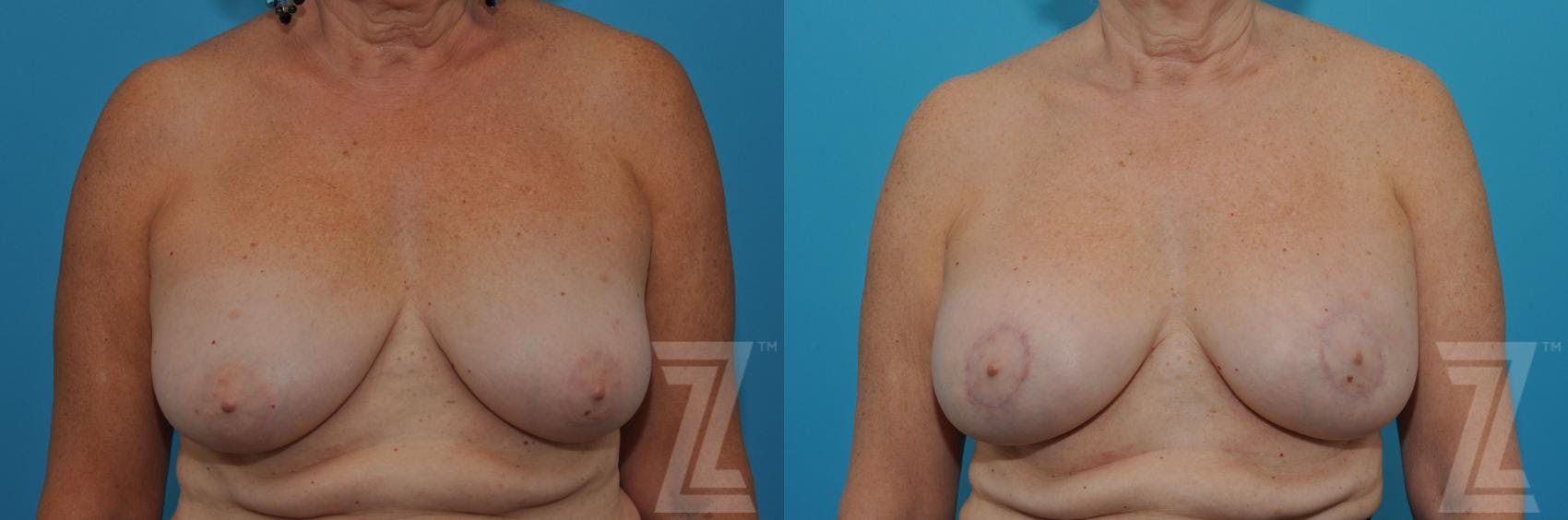 Breast Augmentation Revision Before & After Gallery - Patient 132886586 - Image 1