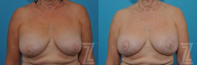 Austin Breast Augmentation Revision Before & After Gallery - Patient 132886586 - Image 1 - The Piazza Center