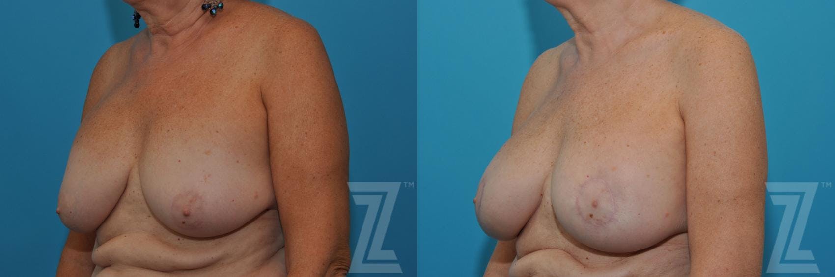 Breast Augmentation Revision Before & After Gallery - Patient 132886586 - Image 2