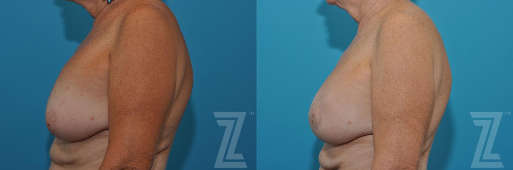 Breast Augmentation Revision Before & After Gallery - Patient 132886586 - Image 3