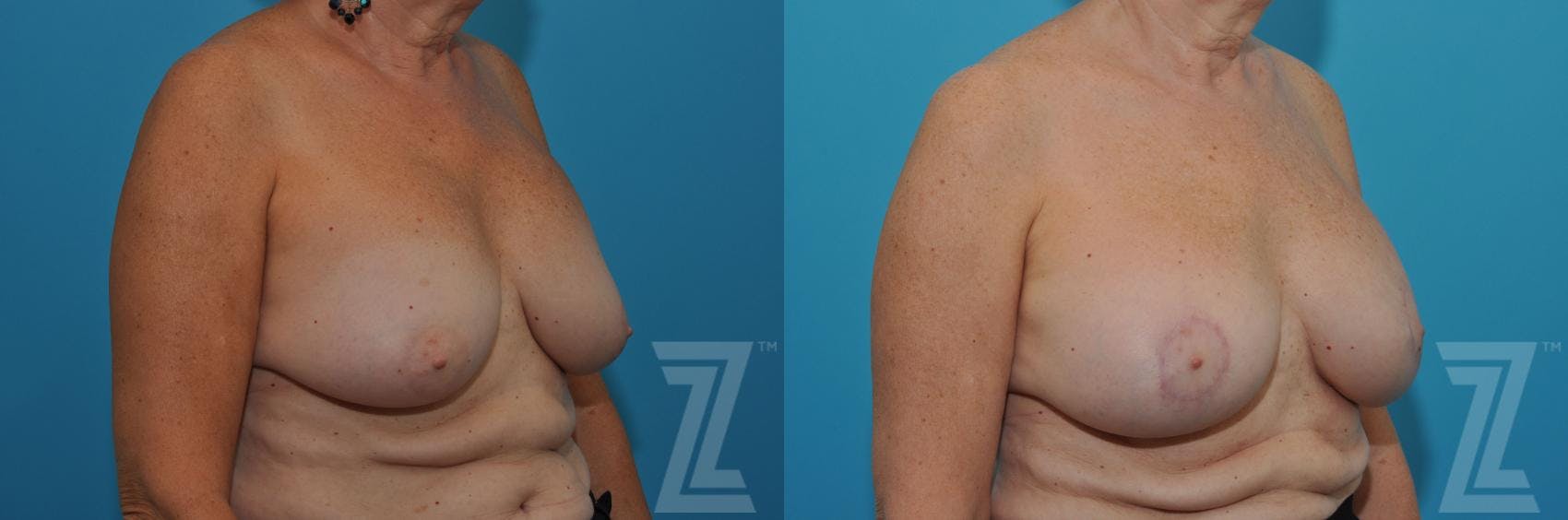 Breast Augmentation Revision Before & After Gallery - Patient 132886586 - Image 4