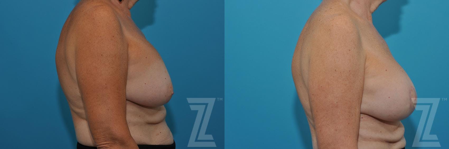 Breast Augmentation Revision Before & After Gallery - Patient 132886586 - Image 5