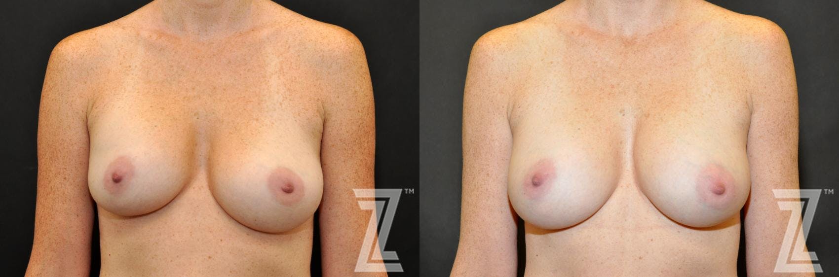 Breast Augmentation Revision Before & After Gallery - Patient 132886587 - Image 1