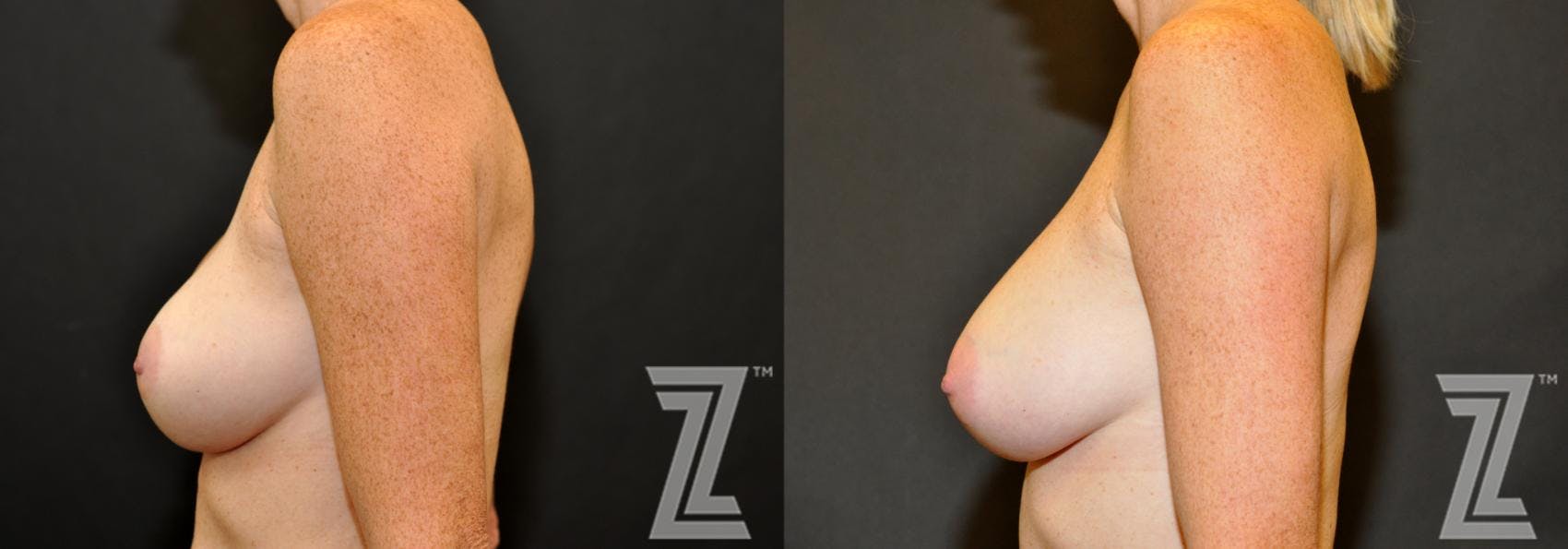 Breast Augmentation Revision Before & After Gallery - Patient 132886587 - Image 3