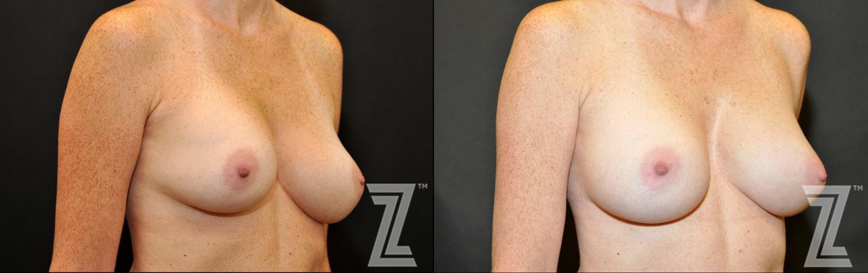 Breast Augmentation Revision Before & After Gallery - Patient 132886587 - Image 4