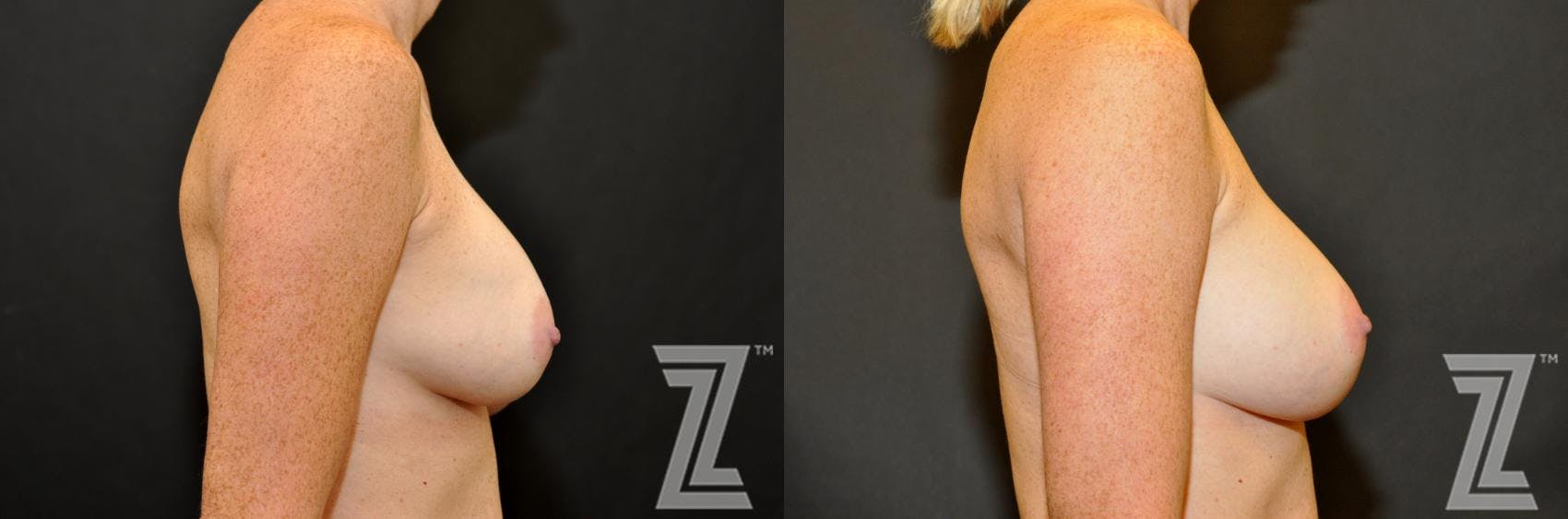 Breast Augmentation Revision Before & After Gallery - Patient 132886587 - Image 5