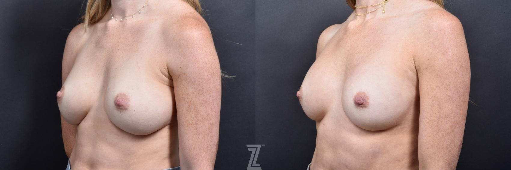 Breast Augmentation Revision Before & After Gallery - Patient 132886589 - Image 2
