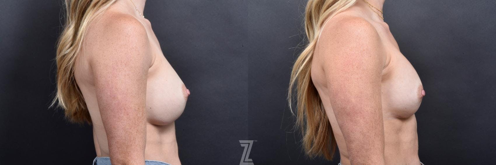 Breast Augmentation Revision Before & After Gallery - Patient 132886589 - Image 5