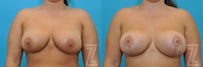 Breast Augmentation Revision Before & After Gallery - Patient 132886591 - Image 1