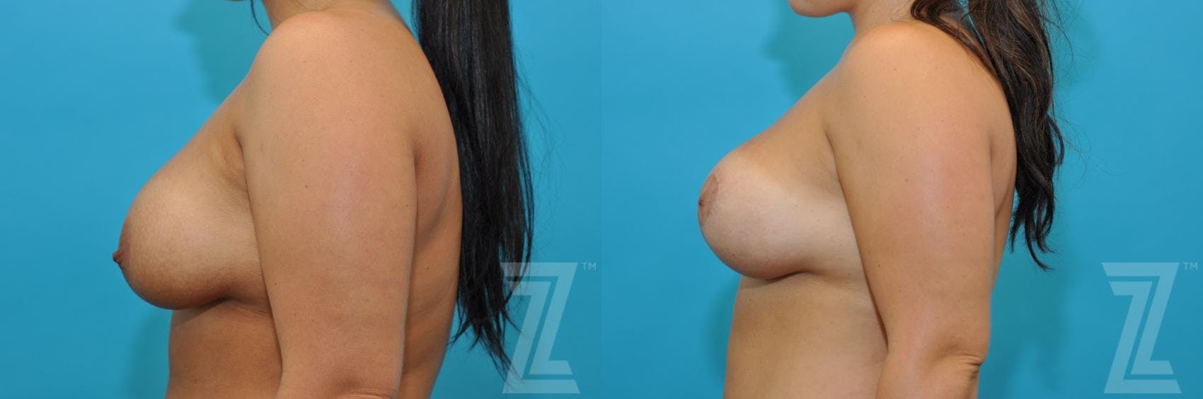Breast Augmentation Revision Before & After Gallery - Patient 132886591 - Image 3