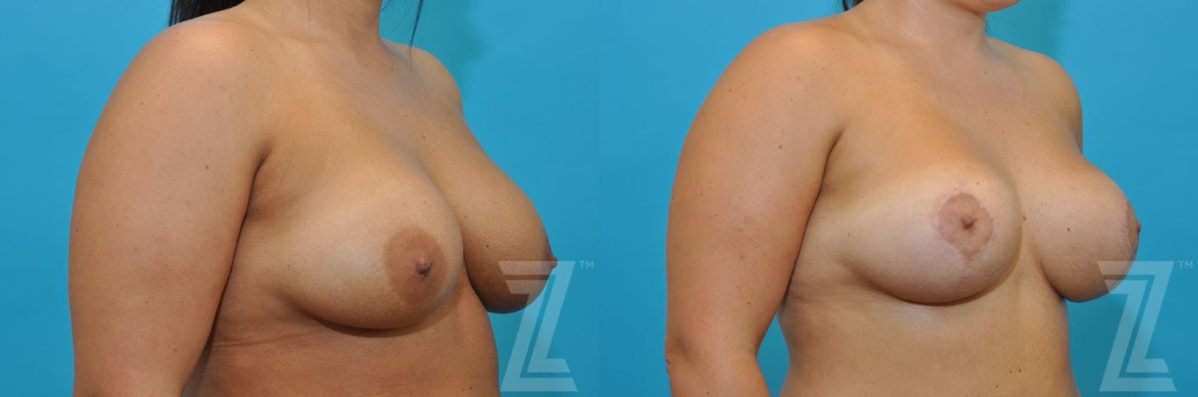 Breast Augmentation Revision Before & After Gallery - Patient 132886591 - Image 4