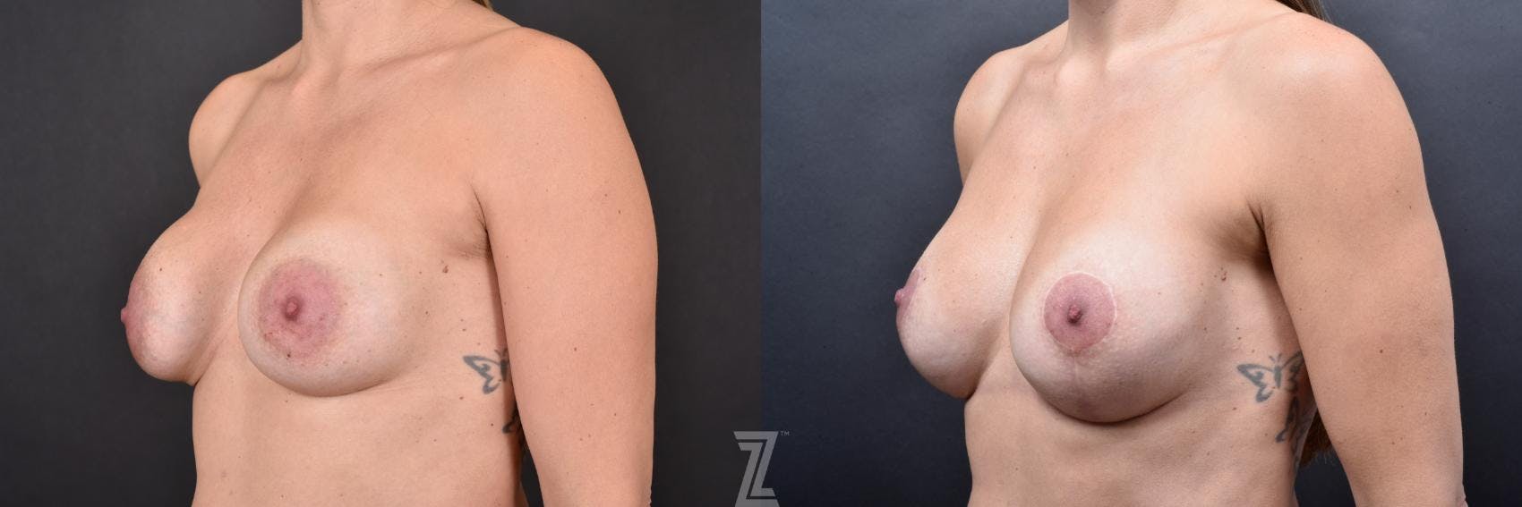 Breast Augmentation Revision Before & After Gallery - Patient 132886593 - Image 2
