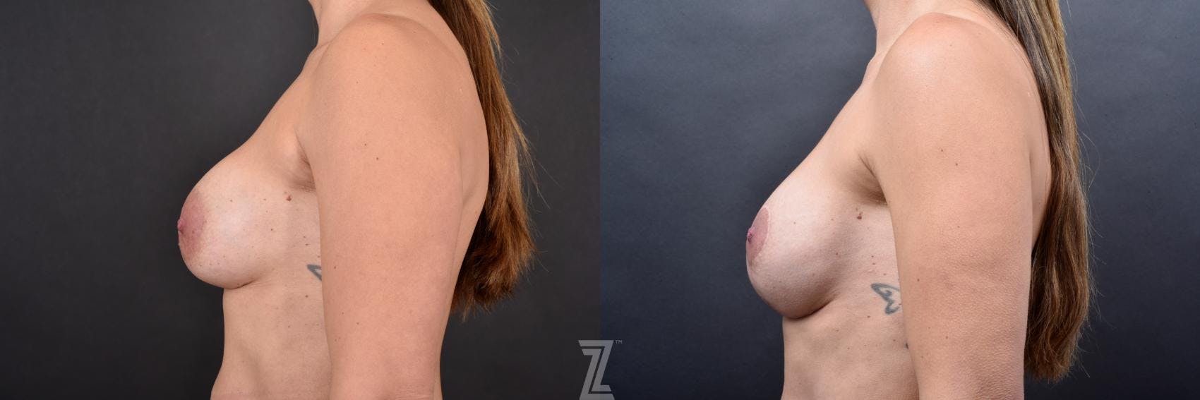 Breast Augmentation Revision Before & After Gallery - Patient 132886593 - Image 3