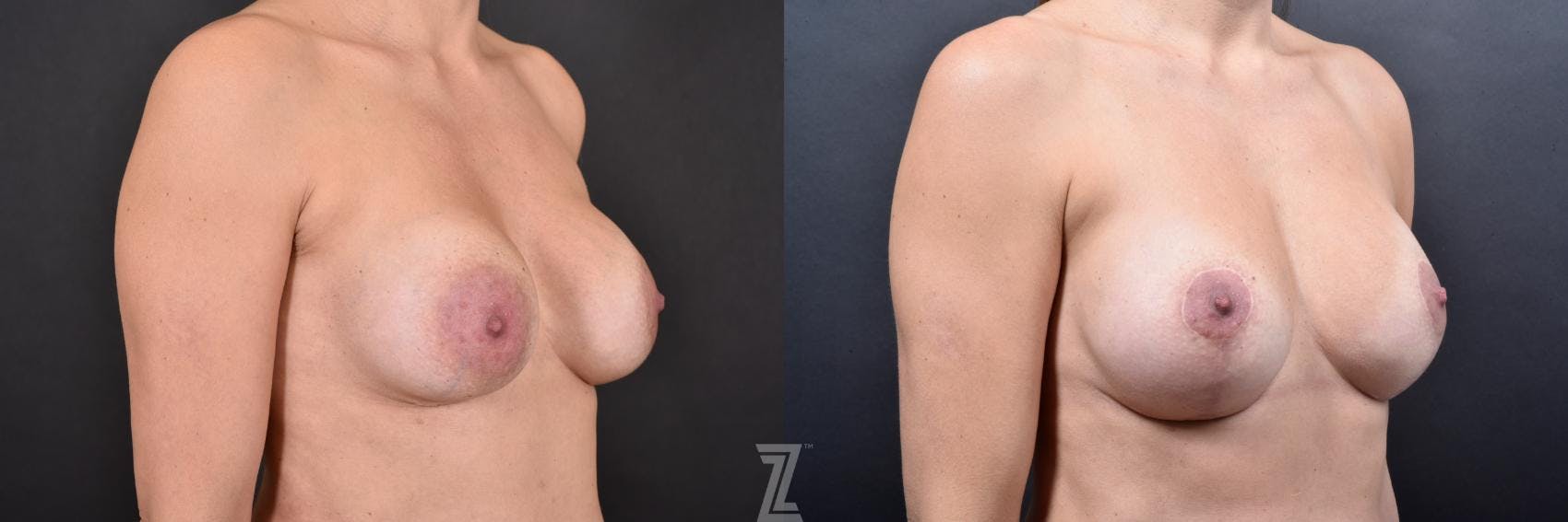 Breast Augmentation Revision Before & After Gallery - Patient 132886593 - Image 4