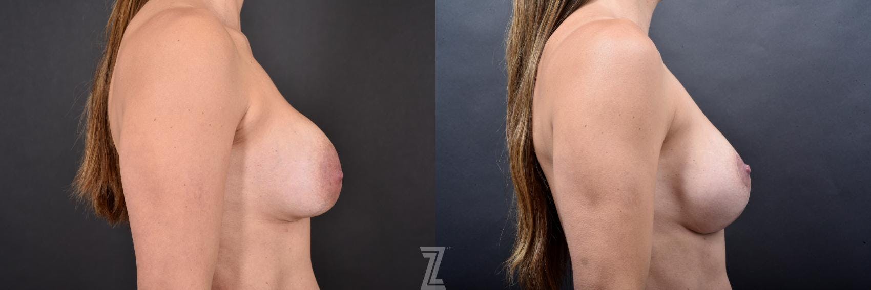 Breast Augmentation Revision Before & After Gallery - Patient 132886593 - Image 5