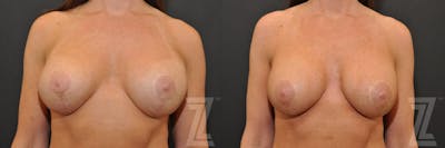 Austin Breast Augmentation Revision Before & After Gallery - Patient 132886594 - Image 1 - The Piazza Center