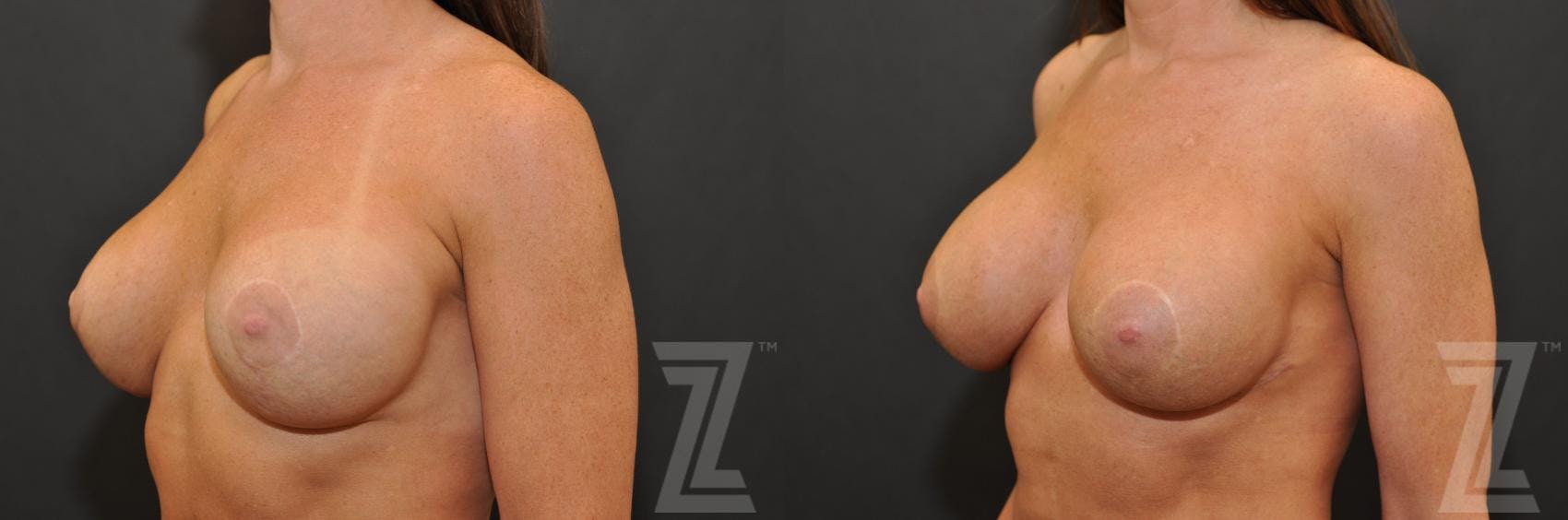 Breast Augmentation Revision Before & After Gallery - Patient 132886594 - Image 2