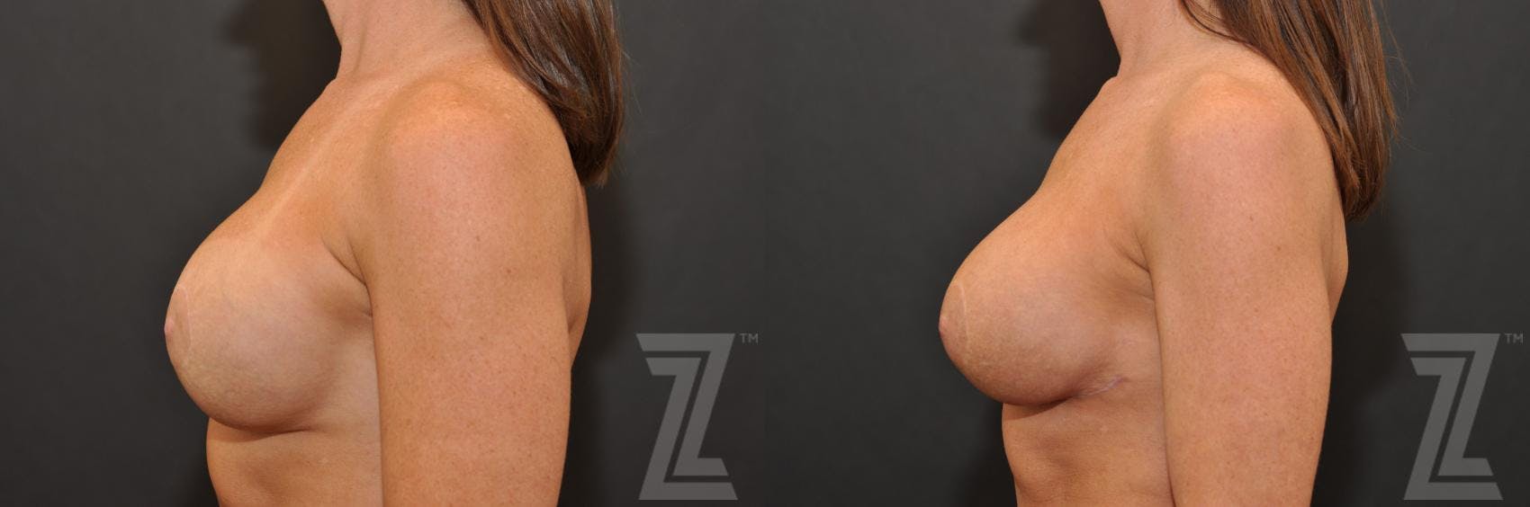 Breast Augmentation Revision Before & After Gallery - Patient 132886594 - Image 3