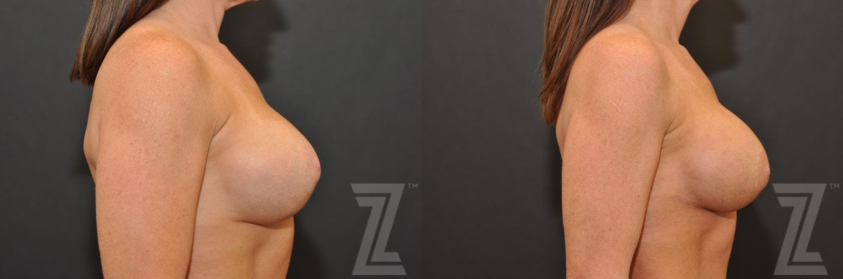 Breast Augmentation Revision Before & After Gallery - Patient 132886594 - Image 5