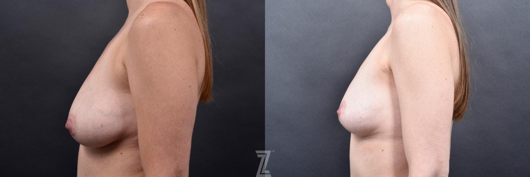 Breast Lift Before & After Gallery - Patient 169938 - Image 3