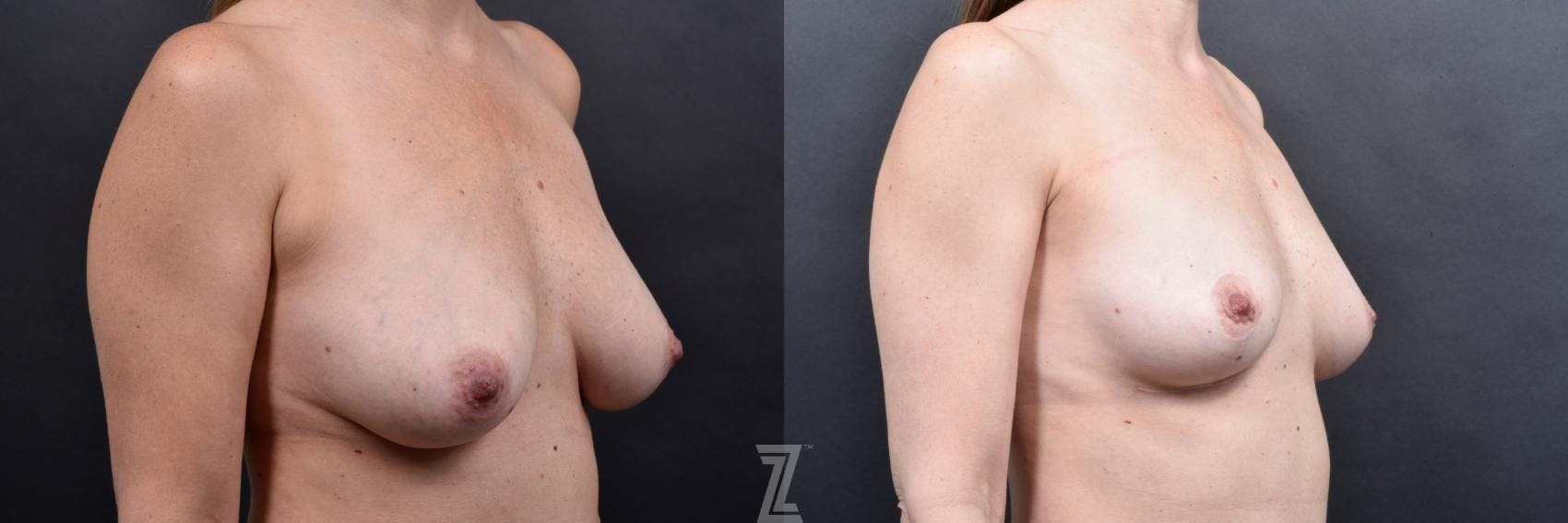 Breast Lift Before & After Gallery - Patient 169938 - Image 4