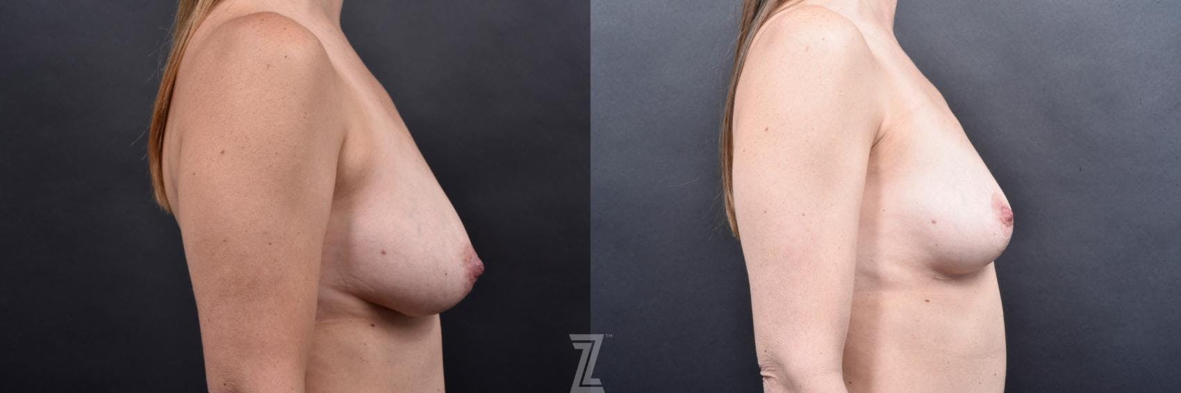 Breast Lift Before & After Gallery - Patient 169938 - Image 5