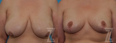Breast Reduction Before & After Gallery - Patient 132886599 - Image 1