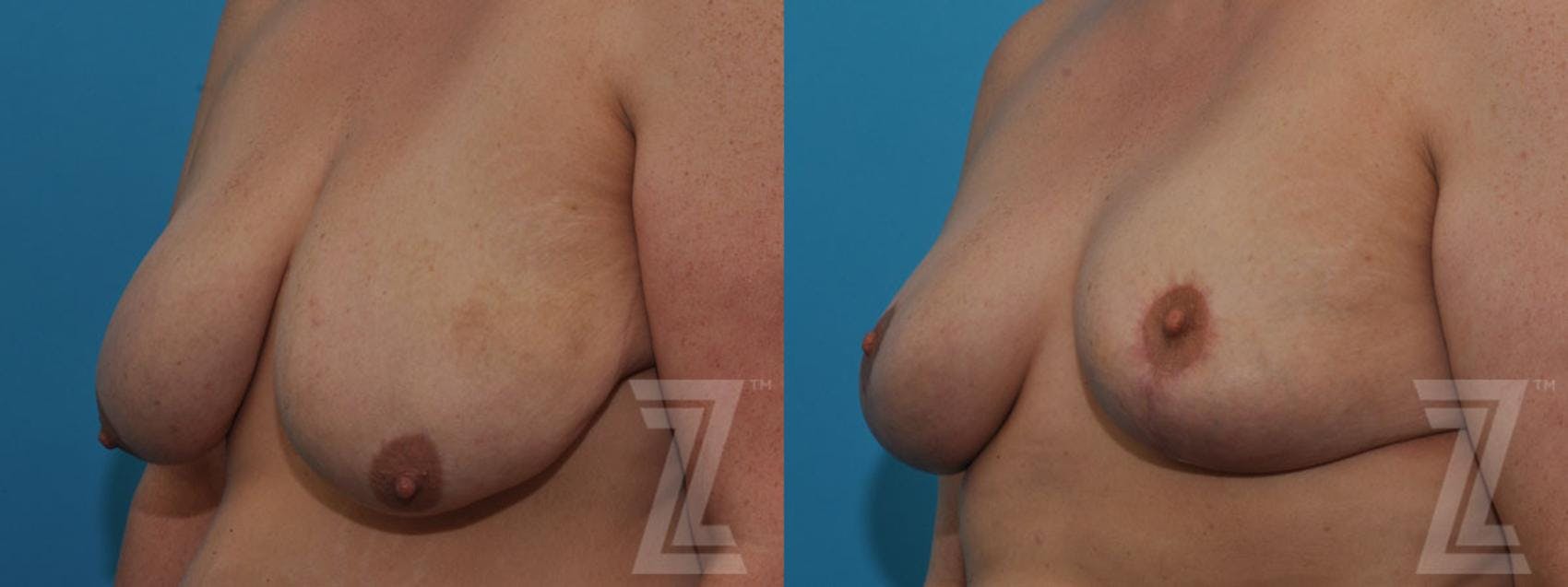 Breast Reduction Before & After Gallery - Patient 132886599 - Image 2