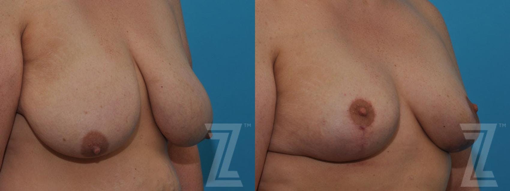 Breast Reduction Before & After Gallery - Patient 132886599 - Image 4