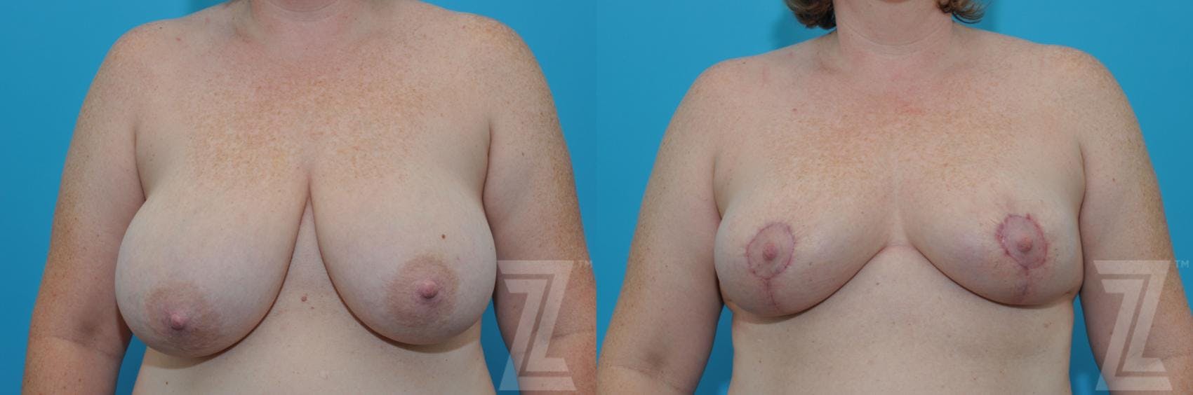 Breast Reduction Before & After Gallery - Patient 132886606 - Image 1