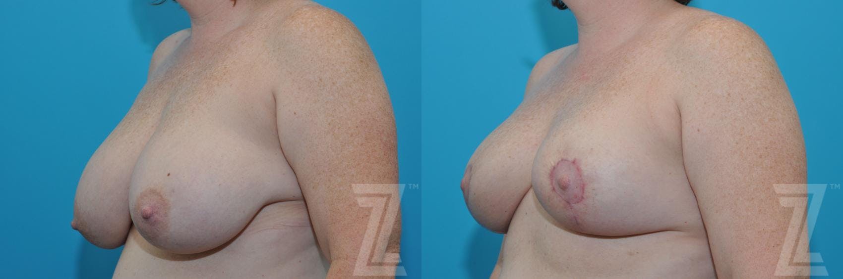 Breast Reduction Before & After Gallery - Patient 132886606 - Image 2