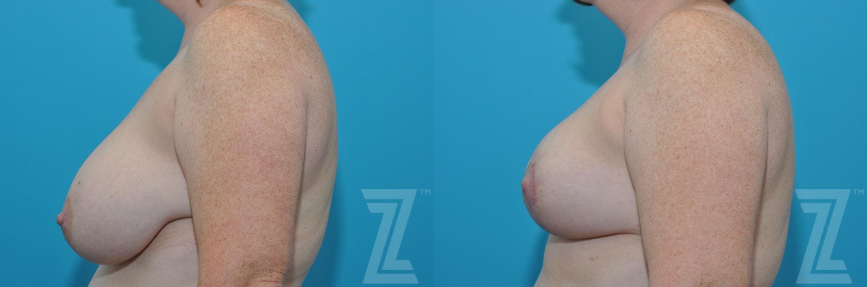 Breast Reduction Before & After Gallery - Patient 132886606 - Image 3