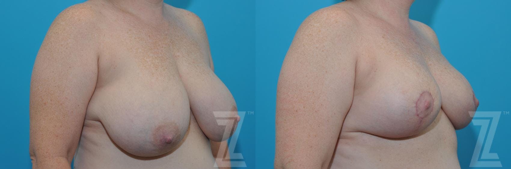 Breast Reduction Before & After Gallery - Patient 132886606 - Image 4
