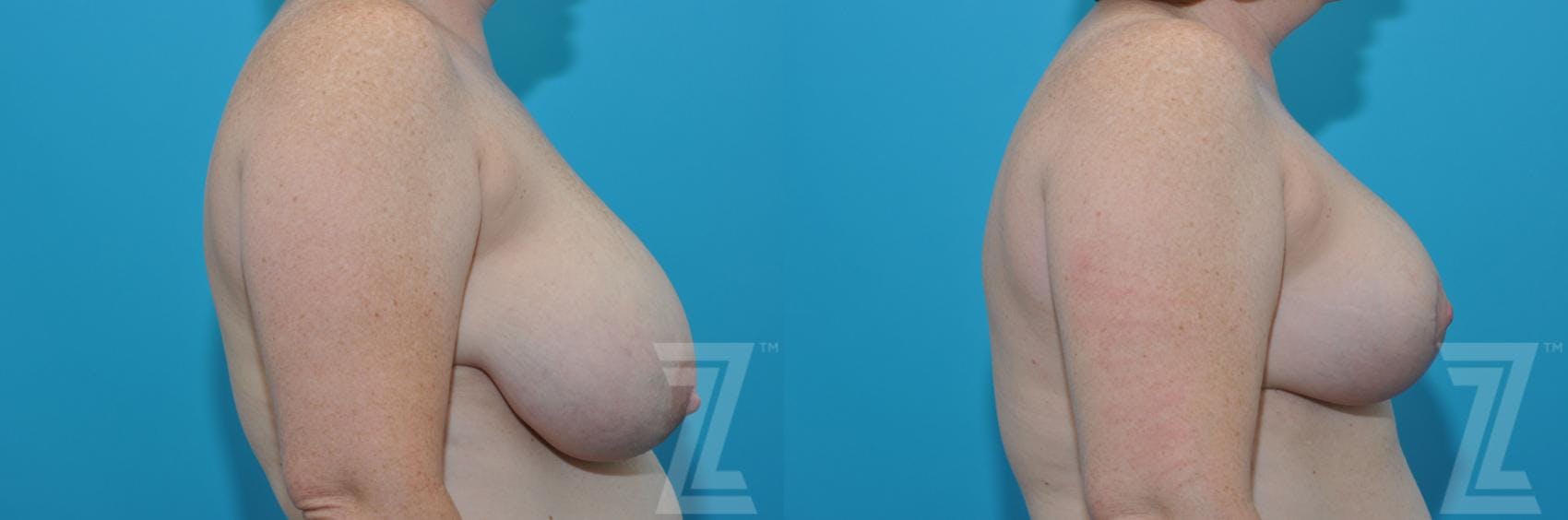 Breast Reduction Before & After Gallery - Patient 132886606 - Image 5