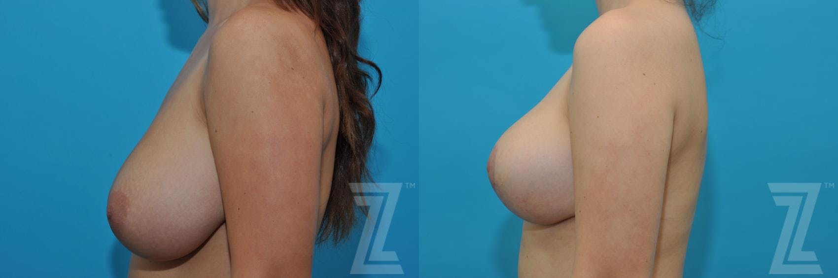 Breast Reduction Before & After Gallery - Patient 132886608 - Image 3
