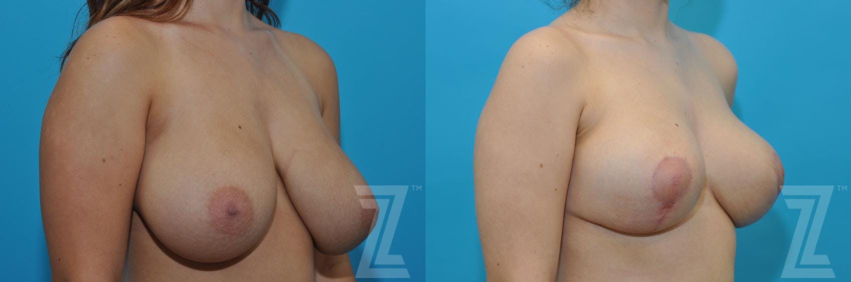 Breast Reduction Before & After Gallery - Patient 132886608 - Image 4