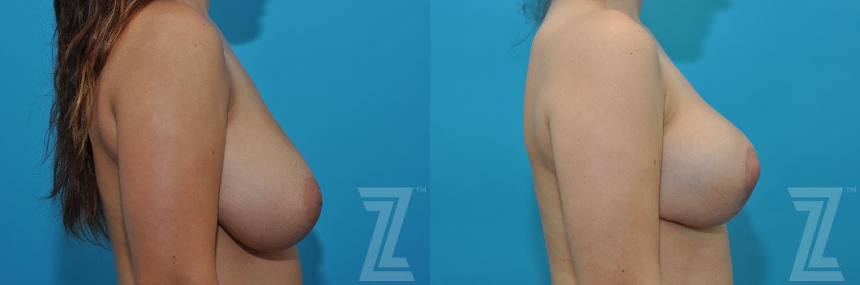 Breast Reduction Before & After Gallery - Patient 132886608 - Image 5