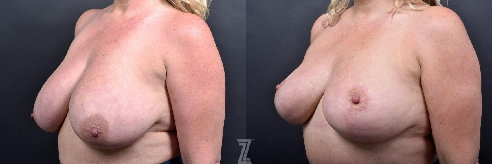 Breast Reduction Before & After Gallery - Patient 132886609 - Image 2