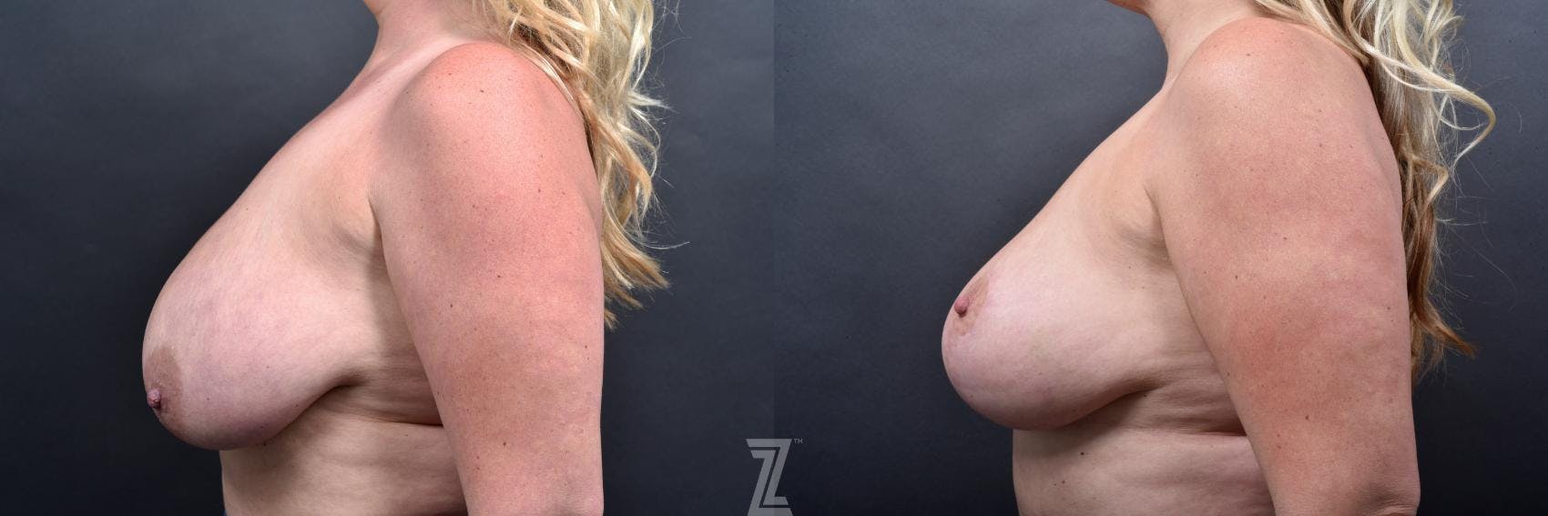 Breast Reduction Before & After Gallery - Patient 132886609 - Image 3