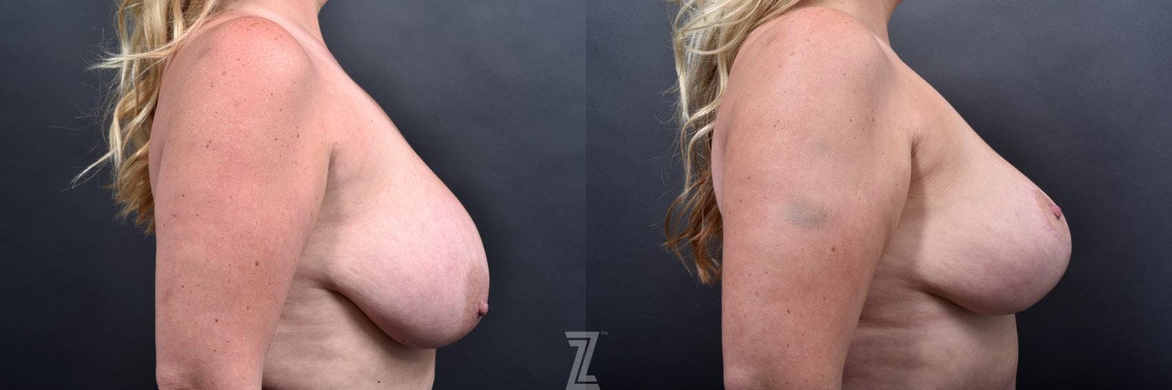 Breast Reduction Before & After Gallery - Patient 132886609 - Image 5