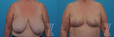 Breast Reduction Before & After Gallery - Patient 132886611 - Image 1