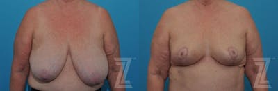 Austin Breast Reduction Before & After Gallery - Patient 132886611 - Image 1 - The Piazza Center