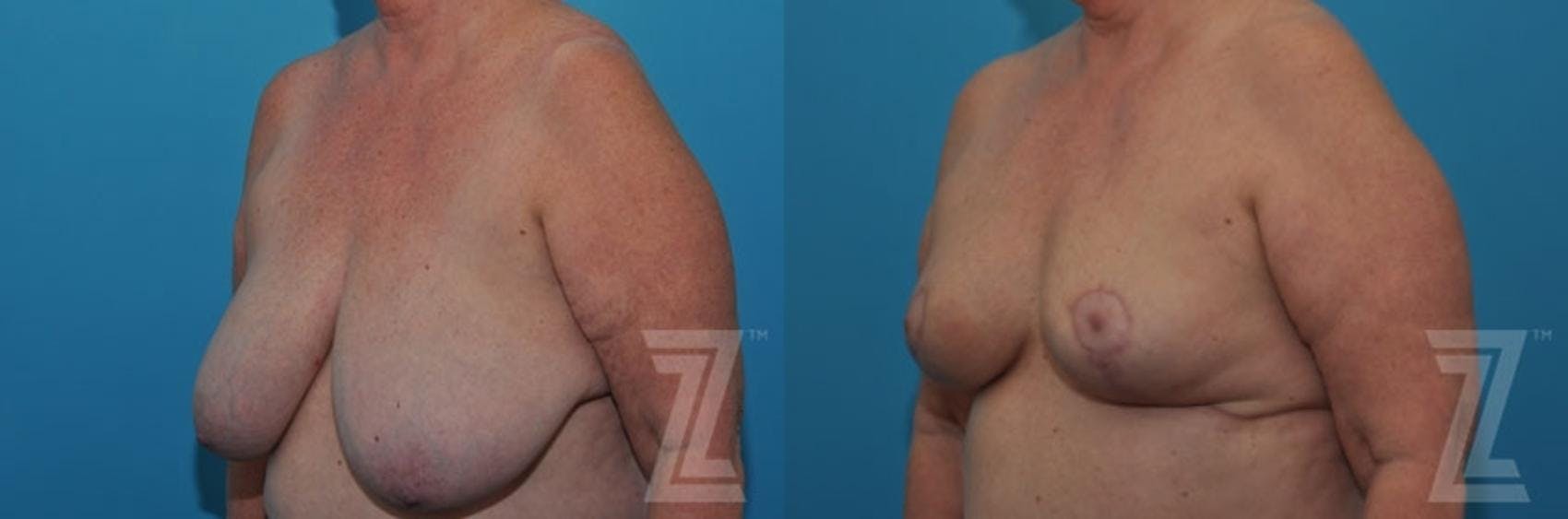 Breast Reduction Before & After Gallery - Patient 132886611 - Image 2