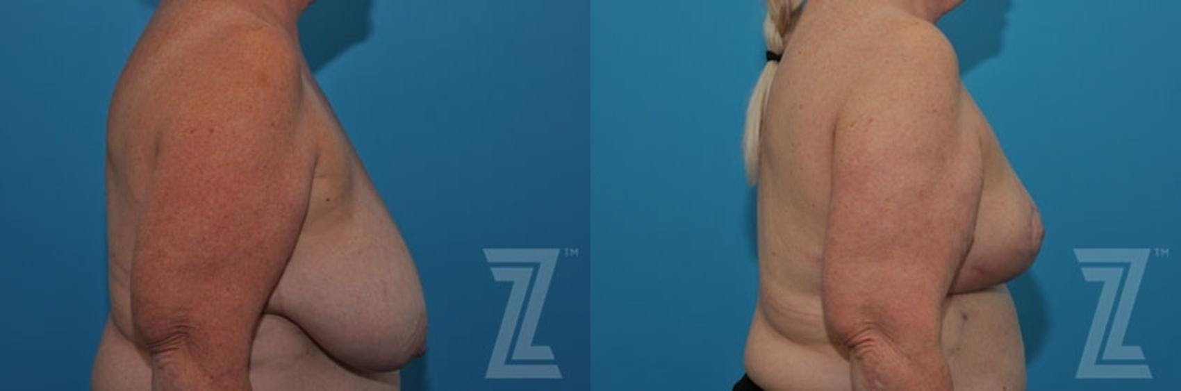 Breast Reduction Before & After Gallery - Patient 132886611 - Image 5