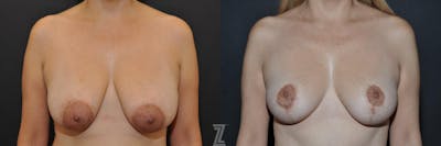 Austin Breast Reduction Before & After Gallery - Patient 132886614 - Image 1 - The Piazza Center