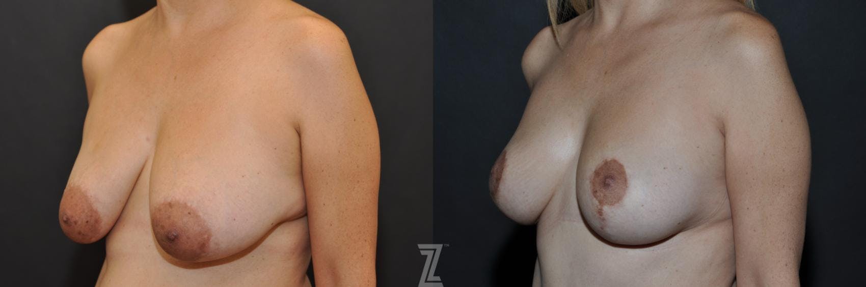 Breast Reduction Before & After Gallery - Patient 132886614 - Image 2