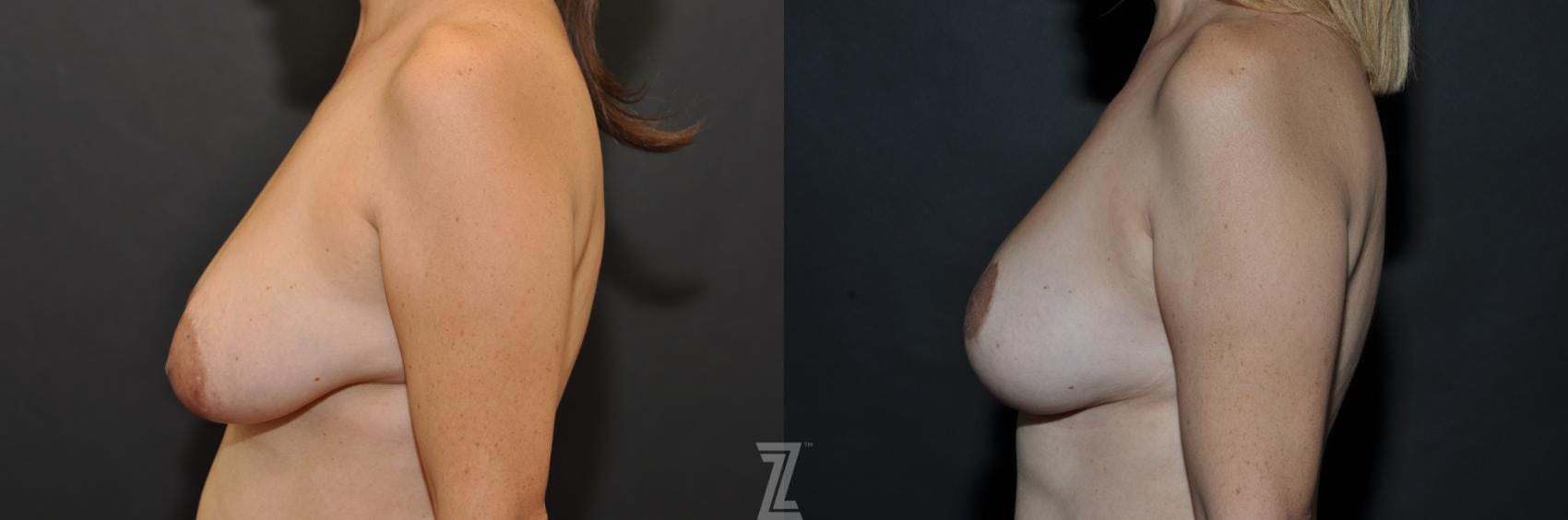 Breast Reduction Before & After Gallery - Patient 132886614 - Image 3