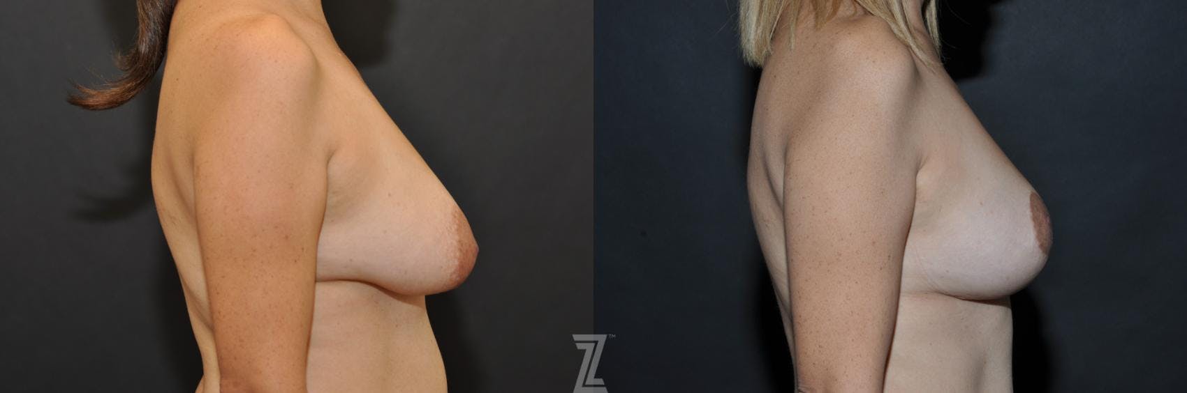 Breast Reduction Before & After Gallery - Patient 132886614 - Image 5